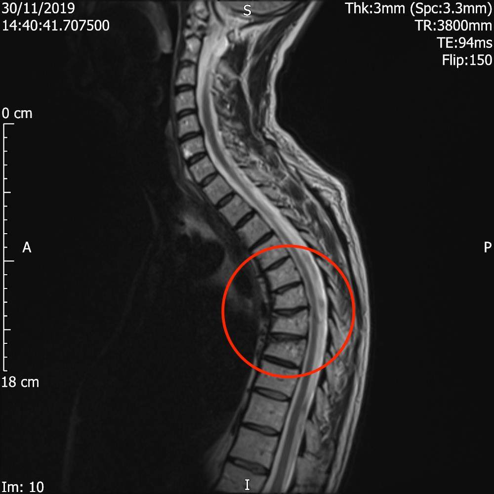 MRI of spine 30112019